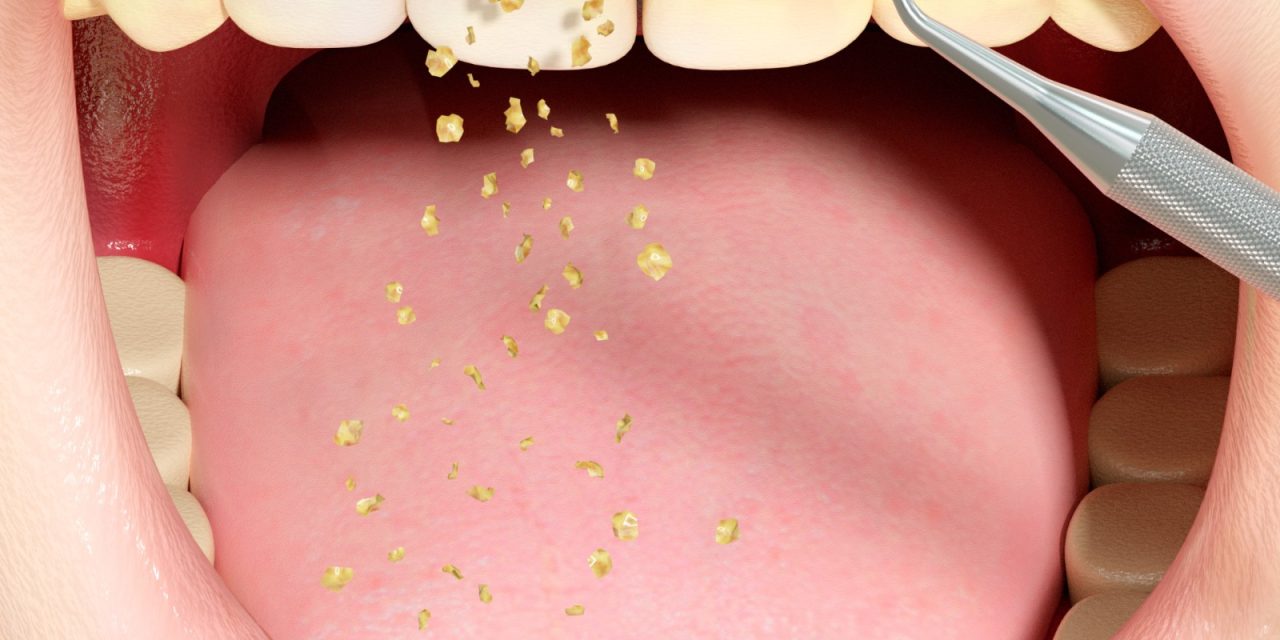 Teeth Cleaning Process & What to Expect At Wadi Al Safa Medical Center, Dubai land.