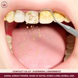 Professional dental cleaning process showing removal of tartar and plaque buildup from teeth at Wadi Al Safa Medical Center, Dubai Land.