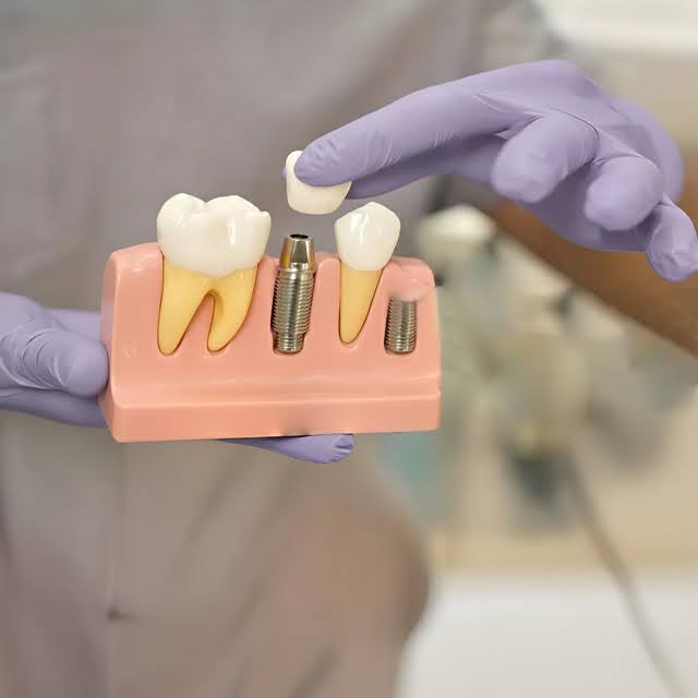 10 Things to Avoid After Tooth Extraction (Complete Guide for Faster Healing)